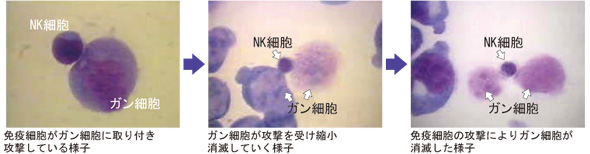 免疫細胞ががん細胞を攻撃・抑制・消滅させる経過(顕微鏡写真)